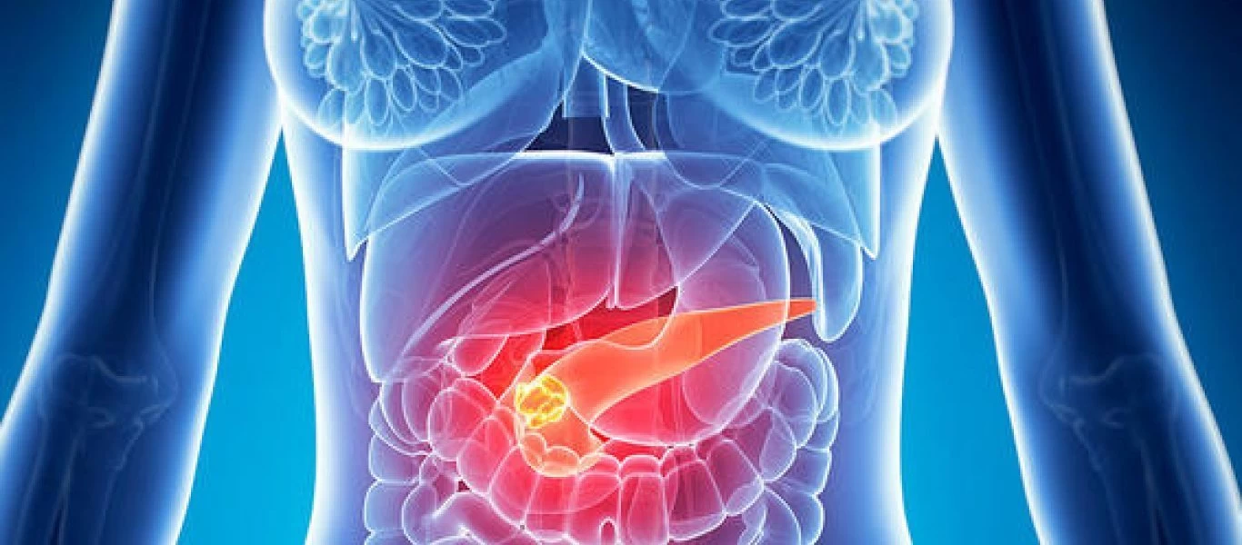 Καρκίνος στο πάγκρεας: Οι δύο τρόποι για να τον εντοπίσει ο οδοντίατρος